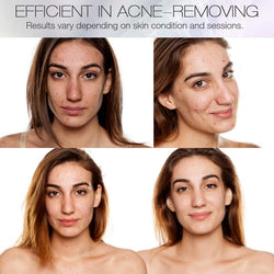 Blue Light Therapy for Acne Deal #19