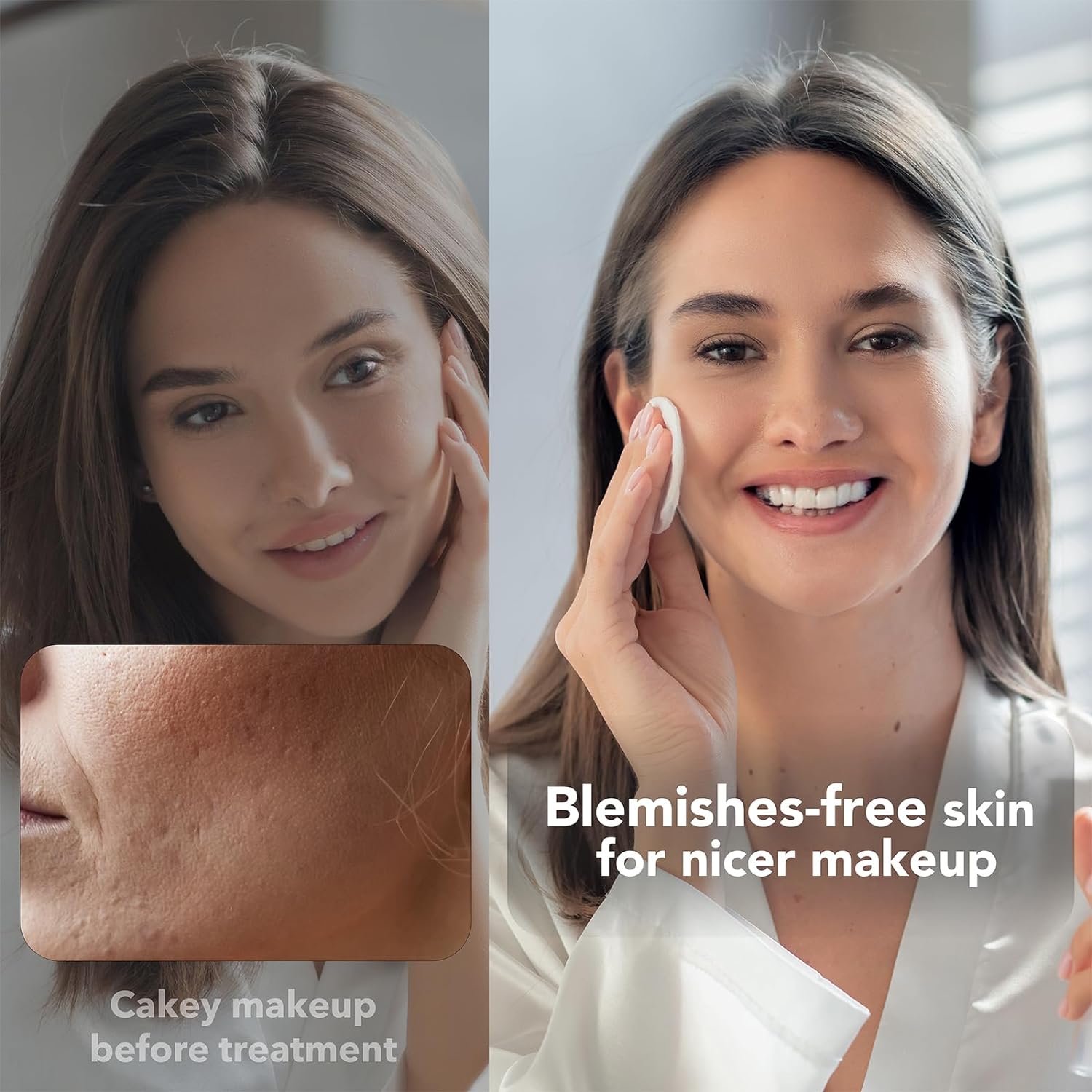 Blue Light Therapy for Acne Deal #19