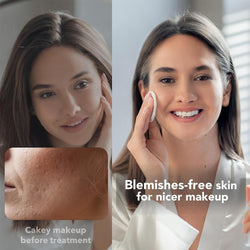 Blue Light Therapy for Acne Deal #19